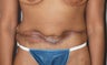Tummy Tuck Revision