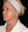 Female patient post 3 months treatment.