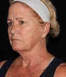 Female patient post 3 months treatment.