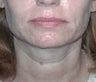 52 year old female patient 