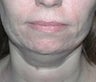 52 year old female patient 