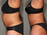39 Year Old Female Treated for Unwanted Fat Upper Lower Abs