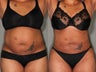 39 Year Old Female Treated for Unwanted Fat Upper Lower Abs