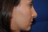 Female Patient Received Rhinoplasty to Remove Bump on Nasal Bridge