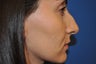 Female Patient Received Rhinoplasty to Remove Bump on Nasal Bridge