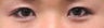 Bilateral Asian Eyelid Surgery