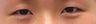 Bilateral Asian Eyelid Surgery