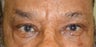 Brow Lift