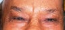 Brow Lift