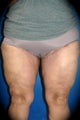 Thighplasty