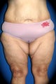 Thighplasty