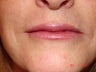 59 year old female with thin lips