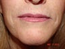 59 year old female with thin lips