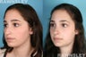 Rhinoplasty