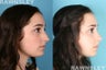 Rhinoplasty