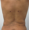 Liposuction