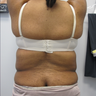 Liposuction