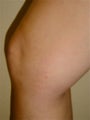 34 year old female with spider veins
