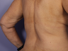 CoolSculpting to Bra Rolls/Back Fat