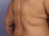 CoolSculpting to Bra Rolls/Back Fat
