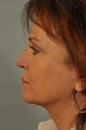 Revision Rhinoplasty