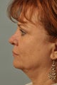 Revision Rhinoplasty