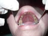 An ill fitting crown was removed and after 15 days of healing, a post and core was done for the fractured remaining tooth.