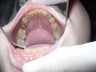 An ill fitting crown was removed and after 15 days of healing, a post and core was done for the fractured remaining tooth.
