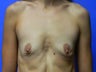 Breast Implants