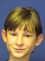 Young male treated for prominent ears with Otoplasty ("Ear Pinning")
