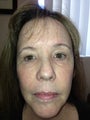Eyelid Surgery and Mixto fractional CO2 laser