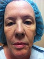 Eyelid Surgery and Mixto fractional CO2 laser