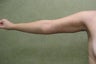 Arm Lift
