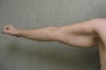 Arm Lift