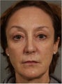 60 year old female 3 years after a Liquid Facelift using Sculpra injections