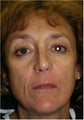 60 year old female 3 years after a Liquid Facelift using Sculpra injections