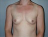 Female patient who underwent a breast augmentation with implants 