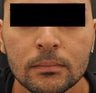 Acne Scarring