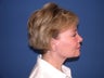 Neck lift