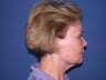 Neck lift