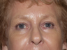 Endoscopic Brow Life