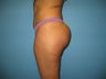 Brazilian buttock