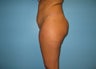 Brazilian buttock