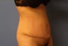 Mommy makeover for severe loss of muscle strength after pregnancy