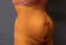 Mommy makeover for severe loss of muscle strength after pregnancy