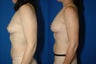 Breast Augmentation