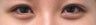 Bilateral Asian Eyelid Surgery