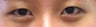 Bilateral Asian Eyelid Surgery