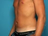 Liposuction