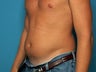 Liposuction